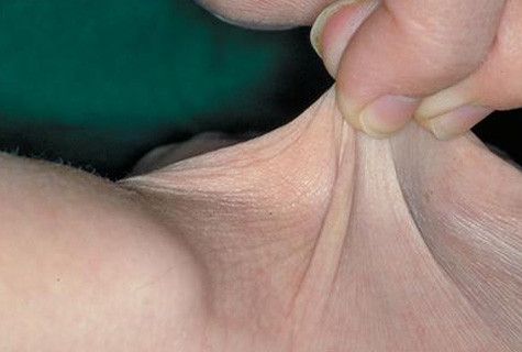 Hội chứng Ehlers- Danlos: Những người bị hội chứng này có một cơ thể linh hoạt phi thường. Da họ có thể bị cấu và kéo dài ra nhưng nói chung rất dễ bị sưng và lâu mới hết sưng. Hội chứng Ehlers- Danlos: Những người bị hội chứng này có một cơ thể linh hoạt phi thường. Da họ có thể bị cấu và kéo dài ra nhưng nói chung rất dễ bị sưng và lâu mới hết sưng.