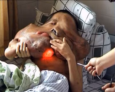 Hiện chỉ có 200 trường hợp trên toàn thế giới được xác nhận kể từ khi căn bệnh này chính thức được phát hiện vào năm 1979. Lúc đầu nó chỉ là một u nhỏ và rất khó để chẩn đoán. Những người mắc bệnh này vẫn có chức năng não và trí thông minh như người bình thường khác.