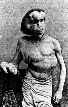 Hội chứng người voi: Người voi Joseph Merrick có lẽ là trường hợp nổi tiếng nhất của hội chứng Proteus. Các nguyên nhân gây ra là do phát triển xương quá mức, tăng trưởng da quá nhiều, và thường đi kèm với khối u. Hội chứng người voi: Người voi Joseph Merrick có lẽ là trường hợp nổi tiếng nhất của hội chứng Proteus. Các nguyên nhân gây ra là do phát triển xương quá mức, tăng trưởng da quá nhiều, và thường đi kèm với khối u.