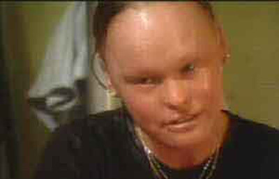 Bệnh vảy cá: Người mắc phải căn bệnh này đều có một làn da dễ tróc, mắt, mũi, tai, miệng đều có xu hướng lộn ra bên ngoài. Căn bệnh này do rối loạn nội tiết da mãn tính khiến da trở nên khô ráp và sần sùi như vảy cá. Bệnh vảy cá: Người mắc phải căn bệnh này đều có một làn da dễ tróc, mắt, mũi, tai, miệng đều có xu hướng lộn ra bên ngoài. Căn bệnh này do rối loạn nội tiết da mãn tính khiến da trở nên khô ráp và sần sùi như vảy cá.