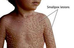 Bệnh đậu mùa: Chúng ta đã nghe nói về bệnh đậu mùa, và có lẽ thường nghe nhiều nhất là tiêm chủng ngừa đậu mùa, tuy vậy, chủng ngừa đậu mùa ngày nay hiếm khi được sử dụng trừ trường hợp có nguy cơ cao của dịch bệnh. Bệnh đậu mùa có triệu chứng đặc trưng như sốt cao, mệt mỏi, phát ban với vết loét màu đỏ lan khắp toàn bộ cơ thể. Bệnh đậu mùa là một trong những bệnh có thể lan nhanh và gây thành đại dịch chết người, có khoảng 300-500 triệu người bị chết vì căn bệnh này trong thế kỷ 20, và 400.000 mỗi năm trong suốt thế kỷ 18. Tuy nhiên, do trên toàn thế giới đã có thuốc tiêm chủng, theo báo cáo trường hợp cuối cùng được ghi nhận của bệnh đậu mùa xuất hiện vào năm 1977. Chính vì vậy, căn bệnh này được cho là rất hiếm vào ngày nay, mối đe dọa của bệnh đậu mùa vẫn còn tồn tại, nhưng dưới hình thức khủng bố sinh học. Bệnh đậu mùa: Chúng ta đã nghe nói về bệnh đậu mùa, và có lẽ thường nghe nhiều nhất là tiêm chủng ngừa đậu mùa, tuy vậy, chủng ngừa đậu mùa ngày nay hiếm khi được sử dụng trừ trường hợp có nguy cơ cao của dịch bệnh. Bệnh đậu mùa có triệu chứng đặc trưng như sốt cao, mệt mỏi, phát ban với vết loét màu đỏ lan khắp toàn bộ cơ thể. Bệnh đậu mùa là một trong những bệnh có thể lan nhanh và gây thành đại dịch chết người, có khoảng 300-500 triệu người bị chết vì căn bệnh này trong thế kỷ 20, và 400.000 mỗi năm trong suốt thế kỷ 18. Tuy nhiên, do trên toàn thế giới đã có thuốc tiêm chủng, theo báo cáo trường hợp cuối cùng được ghi nhận của bệnh đậu mùa xuất hiện vào năm 1977. Chính vì vậy, căn bệnh này được cho là rất hiếm vào ngày nay, mối đe dọa của bệnh đậu mùa vẫn còn tồn tại, nhưng dưới hình thức khủng bố sinh học.