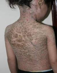 Đây là một loại bệnh di truyền theo đường máu và hoàn toàn không hề lây nhiễm qua tiếp xúc. Những người mắc bệnh vảy cá rất dễ bị vi khuẩn và các tác nhân ô nhiễm khác xâm nhập khiến nguy hiểm đến tính mạng. Đây là một loại bệnh di truyền theo đường máu và hoàn toàn không hề lây nhiễm qua tiếp xúc. Những người mắc bệnh vảy cá rất dễ bị vi khuẩn và các tác nhân ô nhiễm khác xâm nhập khiến nguy hiểm đến tính mạng.