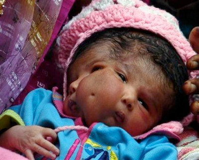 Trẻ em có khiếm khuyết này thường chết non, nhưng một bé gái tên Lali Singh, sinh năm 2008 vẫn sống sót được 2 tháng trước khi chết vì một cơn đau tim. Trẻ em có khiếm khuyết này thường chết non, nhưng một bé gái tên Lali Singh, sinh năm 2008 vẫn sống sót được 2 tháng trước khi chết vì một cơn đau tim.