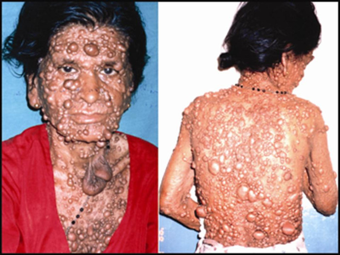 Chúng có thể gây ra các khối u dưới da, các vết sẩm màu trên da, các vấn đề về xương, áp lực trên các rễ thần kinh cột sống, và các vấn đề thần kinh khác. Chúng có thể gây ra các khối u dưới da, các vết sẩm màu trên da, các vấn đề về xương, áp lực trên các rễ thần kinh cột sống, và các vấn đề thần kinh khác.