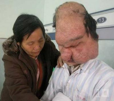 Hội chứng mặt Sư tử (Leontiasis Ossea), cũng được gọi là Leontiasis hoặc Mặt sư tử, là một triệu chứng y khoa hiếm có, đặc trưng bởi phát triển quá mức của xương mặt và sọ. Chúng xảy ra từ từ và gây mất hoàn toàn thị giác do quá trình chèn ép lên các dây thần kinh thị giác do sự phát triển quá mức của xương. Nó cũng có thể có gây khó khăn cho hô hấp của mũi và ăn uống từ miệng. Hội chứng mặt Sư tử (Leontiasis Ossea), cũng được gọi là Leontiasis hoặc Mặt sư tử, là một triệu chứng y khoa hiếm có, đặc trưng bởi phát triển quá mức của xương mặt và sọ. Chúng xảy ra từ từ và gây mất hoàn toàn thị giác do quá trình chèn ép lên các dây thần kinh thị giác do sự phát triển quá mức của xương. Nó cũng có thể có gây khó khăn cho hô hấp của mũi và ăn uống từ miệng.