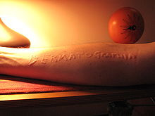 Ở những người có hệ thống miễn dịch quá nhạy cảm, khi da bị tổn thương có vết phồng nhẹ, 1 lượng lớn hixtamin được giải phóng qua da làm các mao mạch giãn nở và xuất hiện những đường lằn roi (xuất hiện trong khoảng 30 phút). Bệnh này không quá nguy hiểm. Ở những người có hệ thống miễn dịch quá nhạy cảm, khi da bị tổn thương có vết phồng nhẹ, 1 lượng lớn hixtamin được giải phóng qua da làm các mao mạch giãn nở và xuất hiện những đường lằn roi (xuất hiện trong khoảng 30 phút). Bệnh này không quá nguy hiểm.