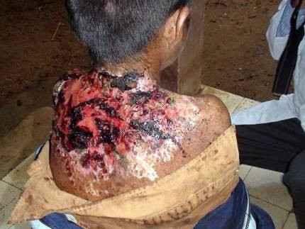 Hiện nay vẫn chưa thể kết luận được đây là hiện tượng ngẫu nhiên hay do ảnh hưởng của môi trường. Hiện ngành y cũng chưa có nghiên cứu nào về vấn đề này và chưa có phác đồ điều trị dứt điểm. Hiện nay vẫn chưa thể kết luận được đây là hiện tượng ngẫu nhiên hay do ảnh hưởng của môi trường. Hiện ngành y cũng chưa có nghiên cứu nào về vấn đề này và chưa có phác đồ điều trị dứt điểm.