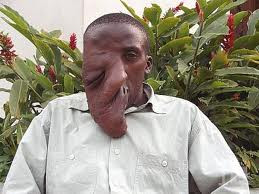 Bệnh Neurofibromatosis hoặc bệnh von Recklinghausen: là bệnh do rối loạn có tính di truyền, trong đó các mô thần kinh phát triển thành các khối u (neurofibromas) có thể là lành tính hoặc có thể gây ra những tổn hại nghiêm trọng bởi sự chèn ép của các dây thần kinh lên các mô khác. Bệnh Neurofibromatosis hoặc bệnh von Recklinghausen: là bệnh do rối loạn có tính di truyền, trong đó các mô thần kinh phát triển thành các khối u (neurofibromas) có thể là lành tính hoặc có thể gây ra những tổn hại nghiêm trọng bởi sự chèn ép của các dây thần kinh lên các mô khác.