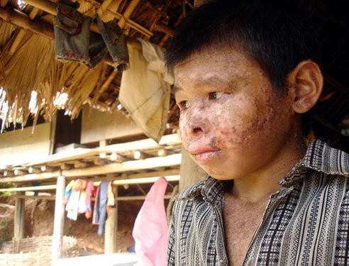 Bệnh khô da đậm sắc tố: Bệnh này có tên khoa học là Xeroderma Pimentosum, căn bệnh này rất hiếm gặp và chưa rõ căn nguyên. Bệnh khô da đậm sắc tố: Bệnh này có tên khoa học là Xeroderma Pimentosum, căn bệnh này rất hiếm gặp và chưa rõ căn nguyên.