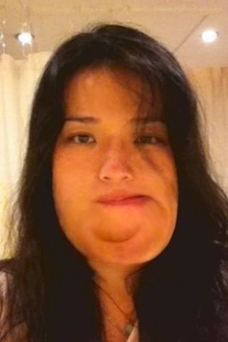 Một vài trường hợp của căn bệnh hiếm gặp này do sự phát triển quá mức của xương ảnh hưởng đến tất cả các xương sọ cũng như tất cả các bộ phận khác trên khuôn mặt, các giác quan bị mất từ từ và người bệnh sẽ chết do các áp lực chèn lên não. Bệnh này không thể chữa khỏi chỉ có cách duy nhất là phẩu thuật cắt bỏ các phần xương phát triển quá mức từng phần hoặc toàn bộ. Một vài trường hợp của căn bệnh hiếm gặp này do sự phát triển quá mức của xương ảnh hưởng đến tất cả các xương sọ cũng như tất cả các bộ phận khác trên khuôn mặt, các giác quan bị mất từ từ và người bệnh sẽ chết do các áp lực chèn lên não. Bệnh này không thể chữa khỏi chỉ có cách duy nhất là phẩu thuật cắt bỏ các phần xương phát triển quá mức từng phần hoặc toàn bộ.