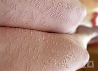 Bệnh Dermatographia: Có thể gọi là bệnh bản đồ. Khi một người mắc chứng bệnh dermatographia có một vết trầy xước trên da của mình, máu sẽ được gia tăng đưa đến nơi trầy xước hơn bình thường. Dermatographia có các triệu chứng như đỏ, ngứa và sưng. Mặc dù điều này không phải là rất nghiêm trọng, nó có thể là khó chịu. Bệnh Dermatographia: Có thể gọi là bệnh bản đồ. Khi một người mắc chứng bệnh dermatographia có một vết trầy xước trên da của mình, máu sẽ được gia tăng đưa đến nơi trầy xước hơn bình thường. Dermatographia có các triệu chứng như đỏ, ngứa và sưng. Mặc dù điều này không phải là rất nghiêm trọng, nó có thể là khó chịu.