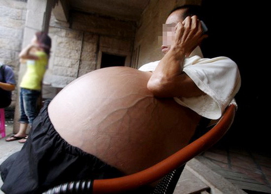 Thai nhi trong bào thai: Đây là một rối loạn rất hiếm gặp trong đó hai bào thai một cách nào đó đã kết nối lại với nhau khi còn trong bụng mẹ Thai nhi trong bào thai: Đây là một rối loạn rất hiếm gặp trong đó hai bào thai một cách nào đó đã kết nối lại với nhau khi còn trong bụng mẹ