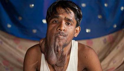 Đối với căn bệnh này dù là lành tính hay ác tính thì biện pháp chữa trị thích hợp nhất là phẫu thuật cắt khối u. Đối với căn bệnh này dù là lành tính hay ác tính thì biện pháp chữa trị thích hợp nhất là phẫu thuật cắt khối u.