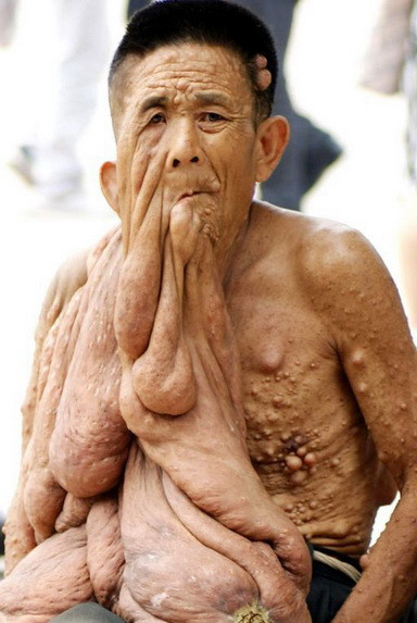 Rối loạn này ảnh hưởng đến tất cả các tế bào mào thần kinh (các tế bào Schwann, tế bào biểu bì tạo hắc tố và các nguyên bào sợi endoneurial). Các phân tử của loại tế bào này sinh sôi nảy nở quá mức trong cơ thể, hình thành các khối u, tế bào biểu bì tạo hắc tố cũng có chức năng bất thường trong bệnh này, dẫn đến rối loạn sắc tố da. Rối loạn này ảnh hưởng đến tất cả các tế bào mào thần kinh (các tế bào Schwann, tế bào biểu bì tạo hắc tố và các nguyên bào sợi endoneurial). Các phân tử của loại tế bào này sinh sôi nảy nở quá mức trong cơ thể, hình thành các khối u, tế bào biểu bì tạo hắc tố cũng có chức năng bất thường trong bệnh này, dẫn đến rối loạn sắc tố da.