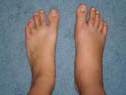 Bong gân: là bong các tổ chức bám quanh khớp sau một chấn động quá mức, là tai biến dễ gặp ở mắt cá chân, bàn chân, khớp gối. Xem thêm: Những món cháo ngon/ Những món ăn bài thuốc Bong gân: là bong các tổ chức bám quanh khớp sau một chấn động quá mức, là tai biến dễ gặp ở mắt cá chân, bàn chân, khớp gối. Xem thêm: Những món cháo ngon/ Những món ăn bài thuốc