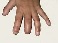 Ngón tay bị cụt do trẻ mắc bệnh gút bẩm sinh tự cắn.