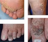 Bệnh á sừng: là một bệnh viêm da cơ địa dị ứng, là một bệnh ngoài da khá phổ biến, có thể gặp ở nhiều vị trí da khác nhau, nhưng rõ rệt nhất là ở các đầu ngón tay, chân, gót chân. Lớp da ở những vị trí này thường khô ráp, róc da, nứt nẻ gây đau đớn. Ảnh: suckhoe365