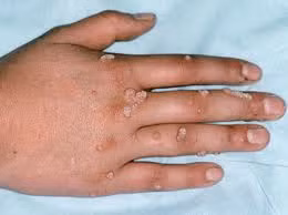 Mụn cóc (mụn cơm): Đây không phải là bệnh ung thư mà là do siêu vi trùng papillomavirus gây nên. Mọi người đều có thể bị mụn cơm trẻ em thường bị nhiều hơn người lớn. Mụn cơm có thể lan truyền từ phần này sang phần khác trong cơ thể hoặc lây từ người này hay người kia. Ảnh: motgiadinh