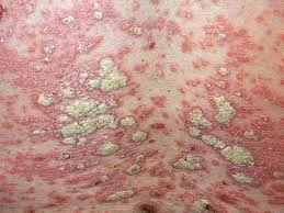 Bệnh vảy nến: là một bệnh mãn tính xảy ra khi các tế bào da phát triển quá nhanh chóng, cơ thể không thể lột da tế bào dư thừa này do đó những mảng vảy màu trắng bạc xếp thành nhiều lớp như sáp nến. Ảnh: tuoitre Bệnh vảy nến: là một bệnh mãn tính xảy ra khi các tế bào da phát triển quá nhanh chóng, cơ thể không thể lột da tế bào dư thừa này do đó những mảng vảy màu trắng bạc xếp thành nhiều lớp như sáp nến. Ảnh: tuoitre