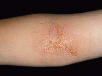 Bệnh hắc lào: là một trong những bệnh nấm da có khả năng lây từ người này sang người khác do sử dụng chung các đồ dùng sinh hoạt như quần, áo, khăn mặt, khăn tắm, ngủ chung giường, đắp chung chăn... Ảnh: tinsuckhoe