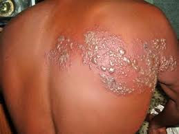 Bệnh zona: Bệnh có tên khoa học là Herpes zoster, bệnh do virút cùng loại vi-rút thuỷ đậu gây nên. Vi-rút này có tên là Varicella zoster. Bệnh zona có thể lây truyền từ người bị nhiễm sang trẻ em hay người lớn mà những người này trước đây không mắc bệnh thuỷ đậu. Ảnh: Phongkhammekong Bệnh zona: Bệnh có tên khoa học là Herpes zoster, bệnh do virút cùng loại vi-rút thuỷ đậu gây nên. Vi-rút này có tên là Varicella zoster. Bệnh zona có thể lây truyền từ người bị nhiễm sang trẻ em hay người lớn mà những người này trước đây không mắc bệnh thuỷ đậu. Ảnh: Phongkhammekong