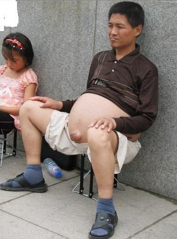 Bệnh mọc 'rễ' trên bụng: Đây là một trong những chứng bệnh đáng sợ mà y học tới nay vẫn chưa tìm thấy lời giải đáp. Một bộ phận trên cơ thể người bỗng mọc thêm 1 ‘vật lạ’; có khi là chiếc đuôi của em bé mới ra đời và có khi là cả một đoạn dài như dây rốn trên bụng. Bệnh mọc 'rễ' trên bụng: Đây là một trong những chứng bệnh đáng sợ mà y học tới nay vẫn chưa tìm thấy lời giải đáp. Một bộ phận trên cơ thể người bỗng mọc thêm 1 ‘vật lạ’; có khi là chiếc đuôi của em bé mới ra đời và có khi là cả một đoạn dài như dây rốn trên bụng.