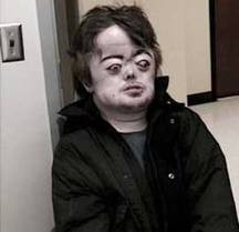 Hội chứng Apert: Hội chứng này xuất hiện là do sự biến đổi trong tinh dịch. Sự biến chuyển này ngăn chặn sự phát triển của đầu óc, khiến các ngón chân và ngón tay dính liền vào nhau và kích thích sự phân chia chuỗi tế bào hình thành nên tinh dịch. Hội chứng Apert: Hội chứng này xuất hiện là do sự biến đổi trong tinh dịch. Sự biến chuyển này ngăn chặn sự phát triển của đầu óc, khiến các ngón chân và ngón tay dính liền vào nhau và kích thích sự phân chia chuỗi tế bào hình thành nên tinh dịch.