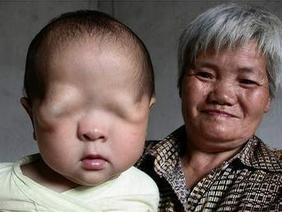 Bệnh không có mắt: hiệt thòi lớn lao đối với em bé sinh ra đã không có cơ hội nhìn thấy thế giới xung quanh. Với những trường hợp tương tự, các bác sỹ có thể dựa trên cấp độ nặng nhẹ và yếu tố hình thành từ ‘căn địa’ người mắc bệnh để tìm ra cách cứu chữa và cải thiện khả quan. Bệnh không có mắt: hiệt thòi lớn lao đối với em bé sinh ra đã không có cơ hội nhìn thấy thế giới xung quanh. Với những trường hợp tương tự, các bác sỹ có thể dựa trên cấp độ nặng nhẹ và yếu tố hình thành từ ‘căn địa’ người mắc bệnh để tìm ra cách cứu chữa và cải thiện khả quan.