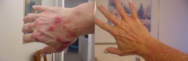 Hiện trên thế giới vẫn chưa tìm ra được nguyên nhân của bệnh này vì chứng ngứa ngáy mà bệnh nhân thường than phiền rất khó hiểu. Bệnh nhân sẽ nói rằng có một thứ gì đó dưới da có thể gây ra chứng trên như ký sinh trùng từ da. Hiện trên thế giới vẫn chưa tìm ra được nguyên nhân của bệnh này vì chứng ngứa ngáy mà bệnh nhân thường than phiền rất khó hiểu. Bệnh nhân sẽ nói rằng có một thứ gì đó dưới da có thể gây ra chứng trên như ký sinh trùng từ da.