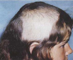 Hội chứng Trichotillomania, tên gọi hội chứng này dùng để miêu tả những người luôn luôn cảm thấy khó chịu với tấm da đầu và toàn bộ những nơi có lông trên cơ thể mình. Họ nhổ hết tóc, cạo hết lông mày, lông mi rồi lông chân, lông tay. Thậm chí đến cả “chỗ ấy” cũng không phải là ngoại lệ. Ngoại trừ vấn đề thích “trụi lông” ra, còn lại hầu hết những người mắc bệnh này có cuộc sống bình thường. Hội chứng Trichotillomania, tên gọi hội chứng này dùng để miêu tả những người luôn luôn cảm thấy khó chịu với tấm da đầu và toàn bộ những nơi có lông trên cơ thể mình. Họ nhổ hết tóc, cạo hết lông mày, lông mi rồi lông chân, lông tay. Thậm chí đến cả “chỗ ấy” cũng không phải là ngoại lệ. Ngoại trừ vấn đề thích “trụi lông” ra, còn lại hầu hết những người mắc bệnh này có cuộc sống bình thường.
