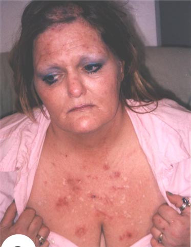 Nguyên nhân của bệnh này là không rõ vì rất khó nắm bắt chứng ngứa ở bệnh nhân. Bệnh nhân thường sẽ kêu ca bị ngứa và muốn gãi liên tục. Bệnh nhân chắc chắn có một cái gì đó dưới da mà có thể lây nhiễm như giun ký sinh. Nguyên nhân của bệnh này là không rõ vì rất khó nắm bắt chứng ngứa ở bệnh nhân. Bệnh nhân thường sẽ kêu ca bị ngứa và muốn gãi liên tục. Bệnh nhân chắc chắn có một cái gì đó dưới da mà có thể lây nhiễm như giun ký sinh.