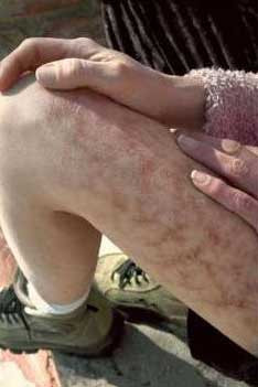 Bệnh Morgellons: Loại bệnh này là một chứng rối loạn da. Morgellons làm cho người bệnh gần như phát điên vì luôn luôn cảm thấy ngứa ngáy không rõ nguyên nhân. Bệnh này vẫn còn gây tranh cãi về khả năng nó tồn tại thực hay chỉ là trí tưởng tượng của các bệnh nhân. Bệnh Morgellons: Loại bệnh này là một chứng rối loạn da. Morgellons làm cho người bệnh gần như phát điên vì luôn luôn cảm thấy ngứa ngáy không rõ nguyên nhân. Bệnh này vẫn còn gây tranh cãi về khả năng nó tồn tại thực hay chỉ là trí tưởng tượng của các bệnh nhân.