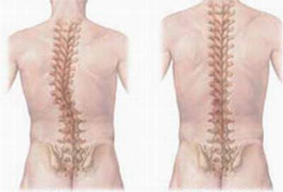 Hình ảnh cột sống bị cong vẹo và cột sống bình thường. Hình ảnh cột sống bị cong vẹo và cột sống bình thường.