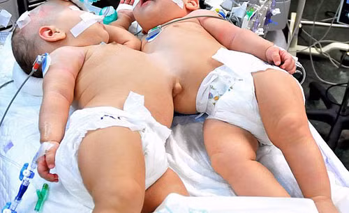 Hai bé gái từng chia sẻ với nhau phần bụng và phần gan - Ảnh: Reuters