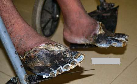 Đôi bàn chân chết đen của anh Toàn Đôi bàn chân chết đen của anh Toàn