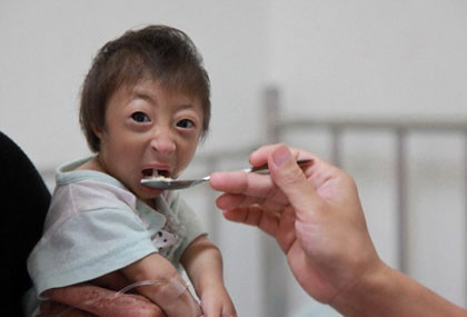 Hiện tại, ông Chandra Bahadur Dangi , 72 tuổi sống tại Nepal với chiều cao 54,6cm đang sở hữu danh hiệu người đàn ông lùn nhất thế giới, trong khi bà Jyoti Amge, chỉ cao 62,8cm là người phụ nữ lùn nhất hành tinh. Hiện tại, ông Chandra Bahadur Dangi , 72 tuổi sống tại Nepal với chiều cao 54,6cm đang sở hữu danh hiệu người đàn ông lùn nhất thế giới, trong khi bà Jyoti Amge, chỉ cao 62,8cm là người phụ nữ lùn nhất hành tinh.