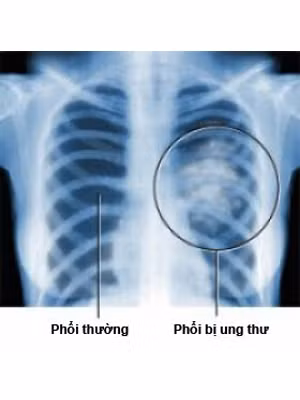 Cảnh báo nhầm lẫn: Viêm phổi. Trên phim chụp Xquang phổi, cả viêm phổi và khối u phổi đều có màu trắng. Viêm phổi sẽ khỏi nhưng sau 4-6 tuần, bạn vẫn cần chụp Xquang lại để kiểm tra. Xét nghiệm: Sinh thiết. Xem thêm:Những thực phẩm không thể "kết đôi" cùng thịt lợn Cảnh báo nhầm lẫn: Viêm phổi. Trên phim chụp Xquang phổi, cả viêm phổi và khối u phổi đều có màu trắng. Viêm phổi sẽ khỏi nhưng sau 4-6 tuần, bạn vẫn cần chụp Xquang lại để kiểm tra. Xét nghiệm: Sinh thiết. Xem thêm:Những thực phẩm không thể "kết đôi" cùng thịt lợn