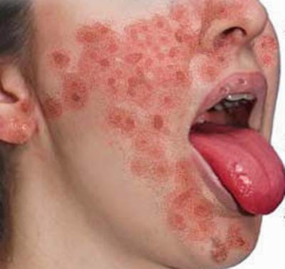 Thiếu vitamin B3 gây viêm da tróc vảy. Thiếu vitamin B3 gây viêm da tróc vảy.