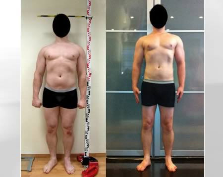 Kéo dài cơ thể thêm hơn 15cm: Một người đàn ông ở New York đã chấp nhận đau đớn để có thể cao thêm 15,24cm thông qua hàng loạt các ca phẫu thuật tăng chiều cao. Bác sĩ phẫu thuật chỉnh hình nổi tiếng – tiến sĩ Dror Paley tuyên bố rằng phần lớn các bệnh nhân đến với trung tâm y tế St. Mary đều có chung 1 lý do. Akash Shukla là một trong những bệnh nhân được Paley thực hiện trực tiếp. Ở tuổi 18, người đàn ông cao 1,5m này đã quyết định tiến hành ca phẫu thuật. Sau khi hoàn thành anh đã cao lên trông thấy so với trước đây. Theo tiết lộ, quá trình này tốn kém khoảng 85.000 đô la Mỹ. Kéo dài cơ thể thêm hơn 15cm: Một người đàn ông ở New York đã chấp nhận đau đớn để có thể cao thêm 15,24cm thông qua hàng loạt các ca phẫu thuật tăng chiều cao. Bác sĩ phẫu thuật chỉnh hình nổi tiếng – tiến sĩ Dror Paley tuyên bố rằng phần lớn các bệnh nhân đến với trung tâm y tế St. Mary đều có chung 1 lý do. Akash Shukla là một trong những bệnh nhân được Paley thực hiện trực tiếp. Ở tuổi 18, người đàn ông cao 1,5m này đã quyết định tiến hành ca phẫu thuật. Sau khi hoàn thành anh đã cao lên trông thấy so với trước đây. Theo tiết lộ, quá trình này tốn kém khoảng 85.000 đô la Mỹ.