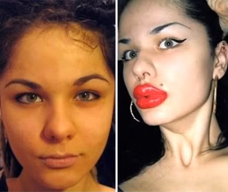 Cô gái Nga bơm môi hơn 100 lần: Người phụ nữ tuyệt vọng này đã được công nhận là người có đôi môi lớn nhất thế giới sau hơn 100 lần bơm môi.