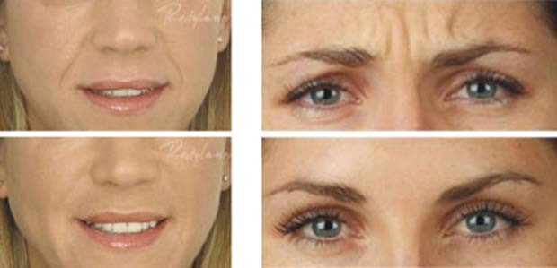Thường khi xuất hiện một nếp nhăn, chị em cho rằng chỉ có cách để phẫu thuật, tiêm botox, laser thì mới có thể thoát khỏi dấu hiệu của tuổi già này. Nhưng có một số cách tự nhiên và an toàn cho da mà có thể nhiều phụ nữ chưa biết. Thường khi xuất hiện một nếp nhăn, chị em cho rằng chỉ có cách để phẫu thuật, tiêm botox, laser thì mới có thể thoát khỏi dấu hiệu của tuổi già này. Nhưng có một số cách tự nhiên và an toàn cho da mà có thể nhiều phụ nữ chưa biết.