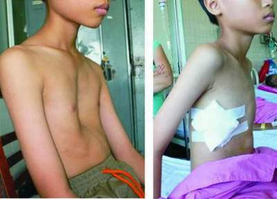 Bệnh nhân trước và sau phẫu thuật lõm ngực. Bệnh nhân trước và sau phẫu thuật lõm ngực.