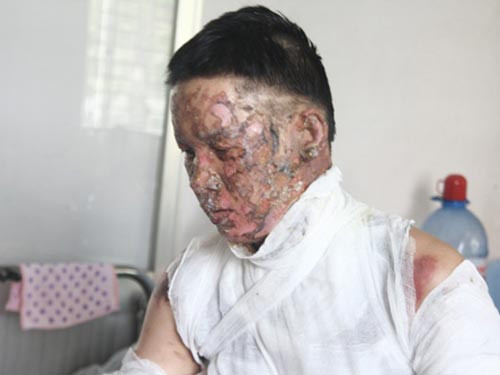 Anh Nam bị phỏng nặng do cồn gây ra trong lúc ăn lẩu