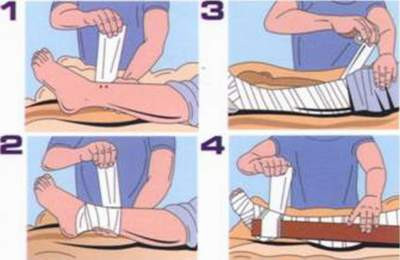 Các thao tác băng bép cố định khi bị rắn độc cắn. Các thao tác băng bép cố định khi bị rắn độc cắn.