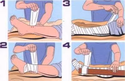 Các thao tác băng bép cố định khi bị rắn độc cắn.