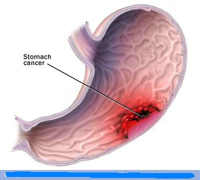 Ung thư dạ dày thường không gây ra triệu chứng gì. Chỉ tới khi bệnh phát triển thì các triệu chứng mới biểu hiện rõ ràng ra ngoài. Tuy nhiên, theo Hiệp hội Ung thư Quốc gia Mỹ có một số triệu chứng mà có thể căn cứ vào đó để chẩn đoán bệnh ung thư dạ dày ở giai đoạn đầu (triệu chứng đầu tiên). Các triệu chứng này bao gồm: Ung thư dạ dày thường không gây ra triệu chứng gì. Chỉ tới khi bệnh phát triển thì các triệu chứng mới biểu hiện rõ ràng ra ngoài. Tuy nhiên, theo Hiệp hội Ung thư Quốc gia Mỹ có một số triệu chứng mà có thể căn cứ vào đó để chẩn đoán bệnh ung thư dạ dày ở giai đoạn đầu (triệu chứng đầu tiên). Các triệu chứng này bao gồm: