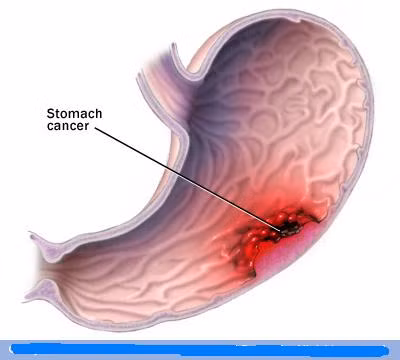 Ung thư dạ dày thường không gây ra triệu chứng gì. Chỉ tới khi bệnh phát triển thì các triệu chứng mới biểu hiện rõ ràng ra ngoài. Tuy nhiên, theo Hiệp hội Ung thư Quốc gia Mỹ có một số triệu chứng mà có thể căn cứ vào đó để chẩn đoán bệnh ung thư dạ dày ở giai đoạn đầu (triệu chứng đầu tiên). Các triệu chứng này bao gồm: