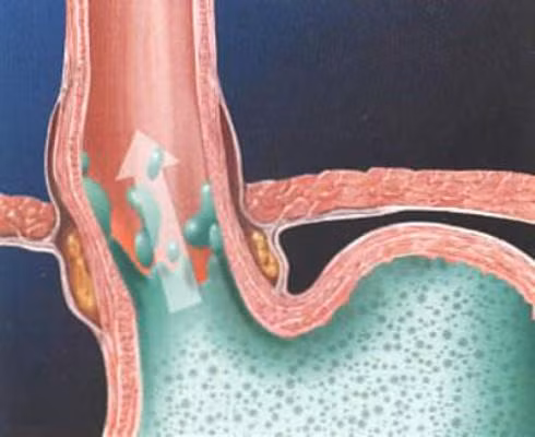Trào ngược dạ dày thực quản: Theo một số nghiên cứu mới đây, 25% trường hợp ngủ kém chưa rõ nguyên nhân liên quan tới chứng trào ngược dạ dày thực quản hoặc ợ nóng không triệu chứng. Ngoài ngủ không ngon, khi tỉnh dậy, người bệnh thường thấy miệng có vị đắng, chua.