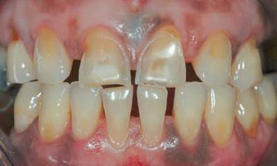 Răng bị mòn sinh lý. Răng bị mòn sinh lý.