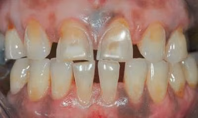 Răng bị mòn sinh lý.